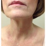 11_after-2-treatments (OXG) (JPG)