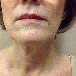 11_before (OXG) (JPG)