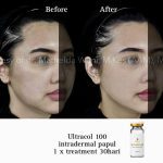 Before After ULTRACOL 100 png