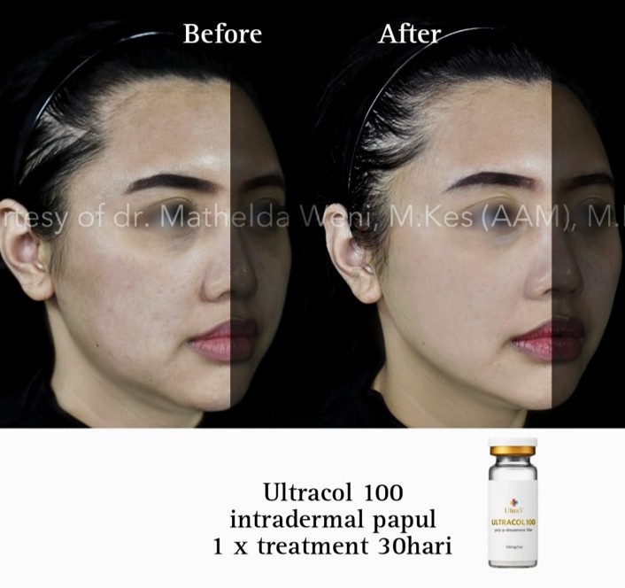 Before After ULTRACOL 100 png
