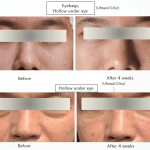 Before After ULTRACOL 200 (1)