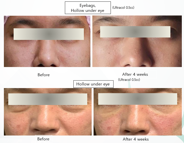 Before After ULTRACOL 200 (1)