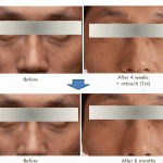 Before After ULTRACOL 200 (2)