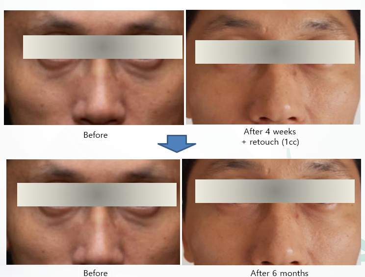 Before After ULTRACOL 200 (2)